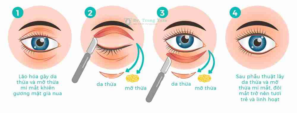 Cắt Da Thừa Mí Mắt Là Gì? Những Lưu Ý Khi Phẩu Thuật Cắt Da Thừa Mí Mắt
