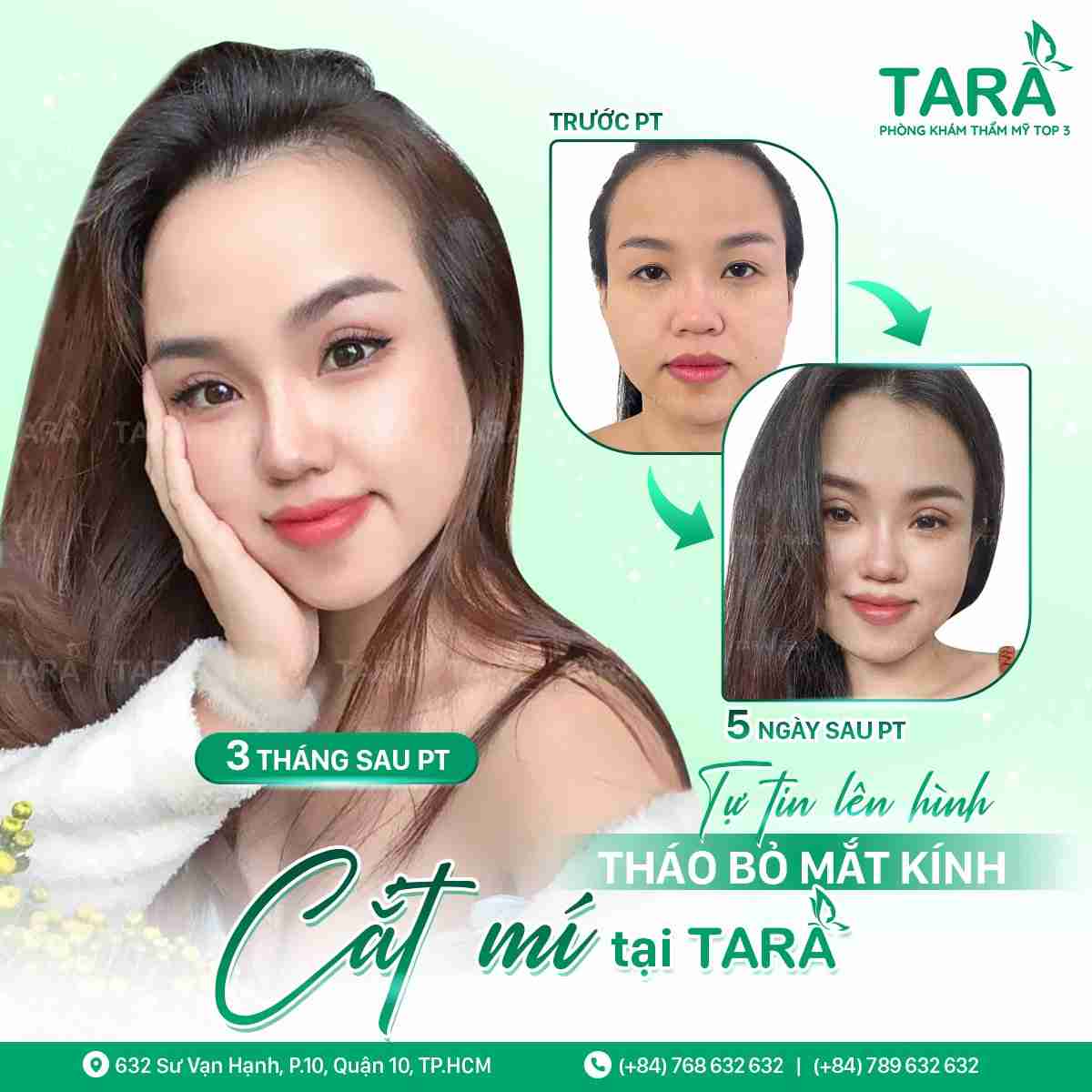 Cắt Da Thừa Mí Mắt Là Gì? Những Lưu Ý Khi Phẩu Thuật Cắt Da Thừa Mí Mắt