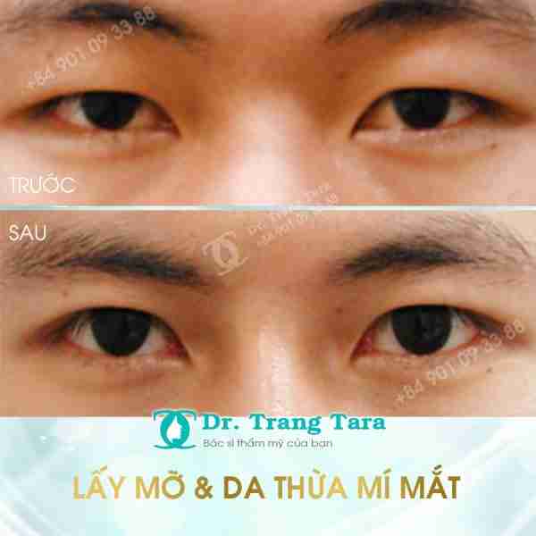 Cắt Da Thừa Mí Mắt Là Gì? Những Lưu Ý Khi Phẩu Thuật Cắt Da Thừa Mí Mắt