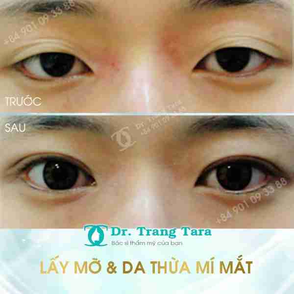 Cắt Da Thừa Mí Mắt Là Gì? Những Lưu Ý Khi Phẩu Thuật Cắt Da Thừa Mí Mắt