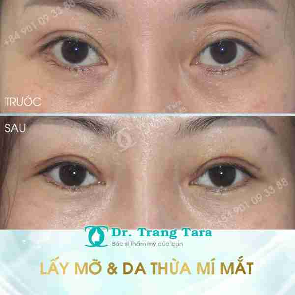 Cắt Da Thừa Mí Mắt Là Gì? Những Lưu Ý Khi Phẩu Thuật Cắt Da Thừa Mí Mắt