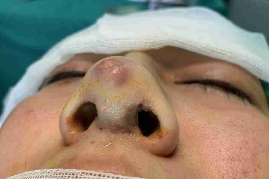 Lộ sụn đầu mũi và dấu hiệu nhận biết để kịp chữa trị