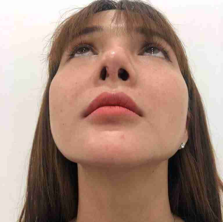 Loại bỏ sụn nhân tạo sau nâng mũi có đau không?