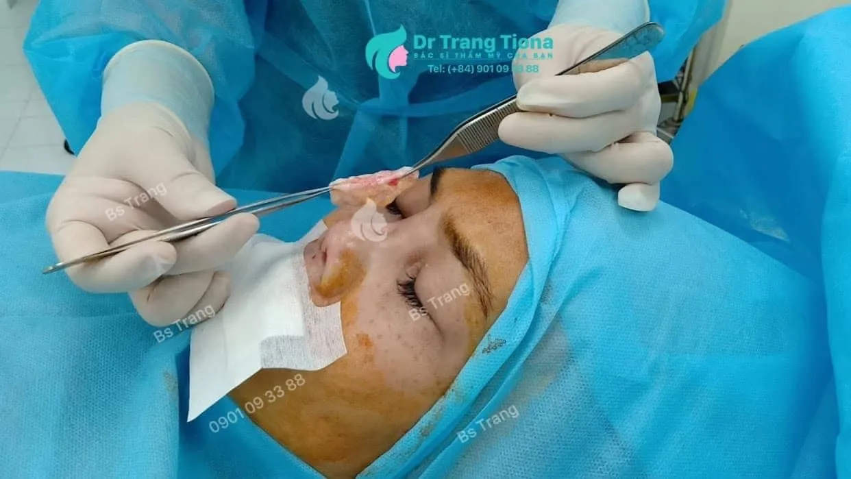 Lợi ích kỳ diệu của việc đặt trung bì mỡ khi tháo sụn mũi