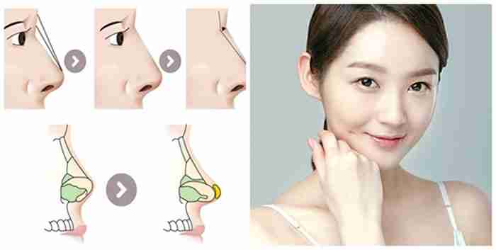 Điểm danh 4 lợi ích nâng mũi bọc sụn Megaderm