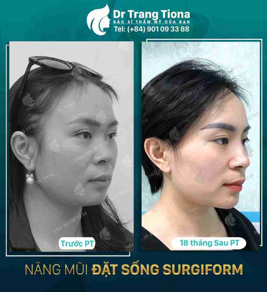 Mũi bị tụt sụn thì phải làm sao? Nguyên nhân và cách điều trị
