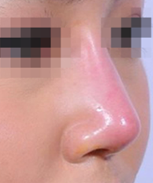 Mũi bị viêm đỏ đầu mũi có cần tháo sụn nâng mũi gấp không?