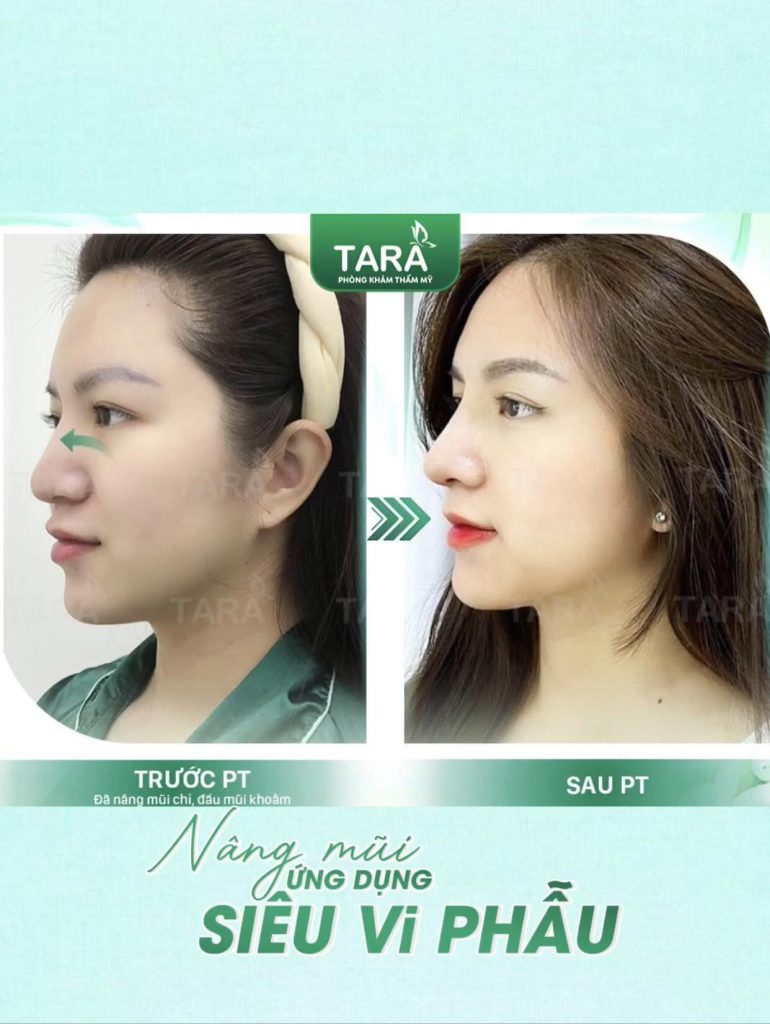 Mũi bị viêm đỏ đầu mũi có cần tháo sụn nâng mũi gấp không?