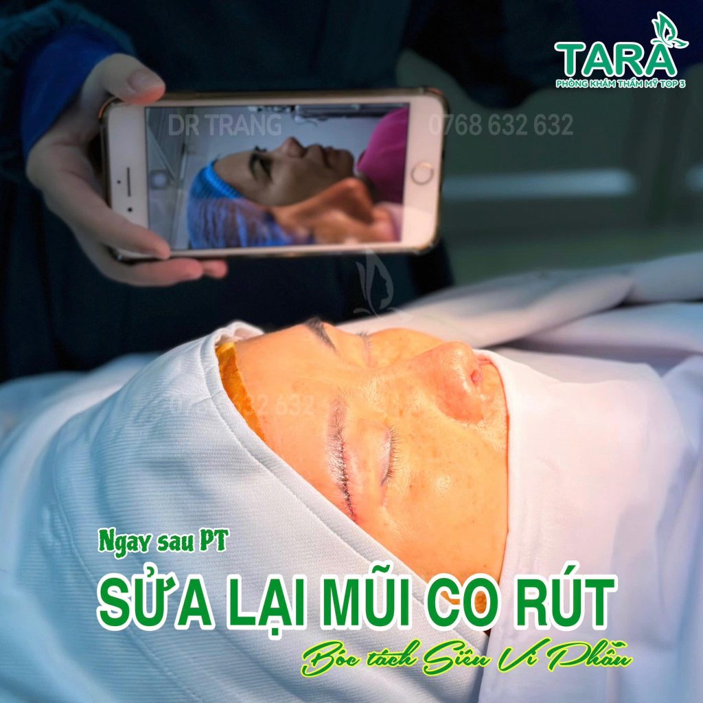 Mũi bị viêm đỏ đầu mũi có cần tháo sụn nâng mũi gấp không?