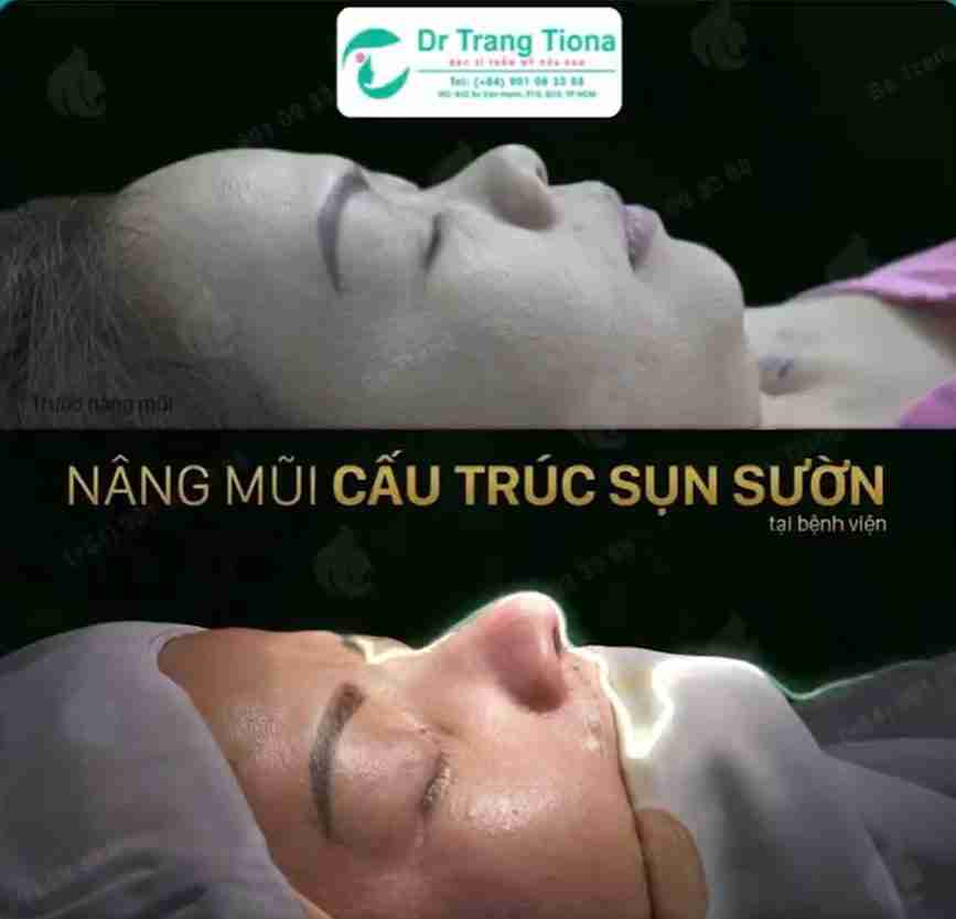 Mũi cà chua là gì? Làm sao sửa mũi cà chua?