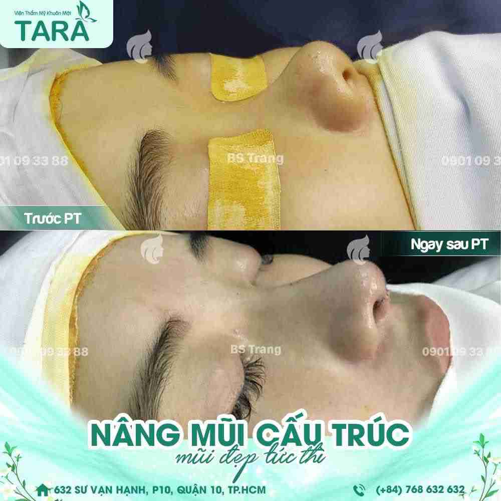 Mũi cà chua là gì? Làm sao sửa mũi cà chua?