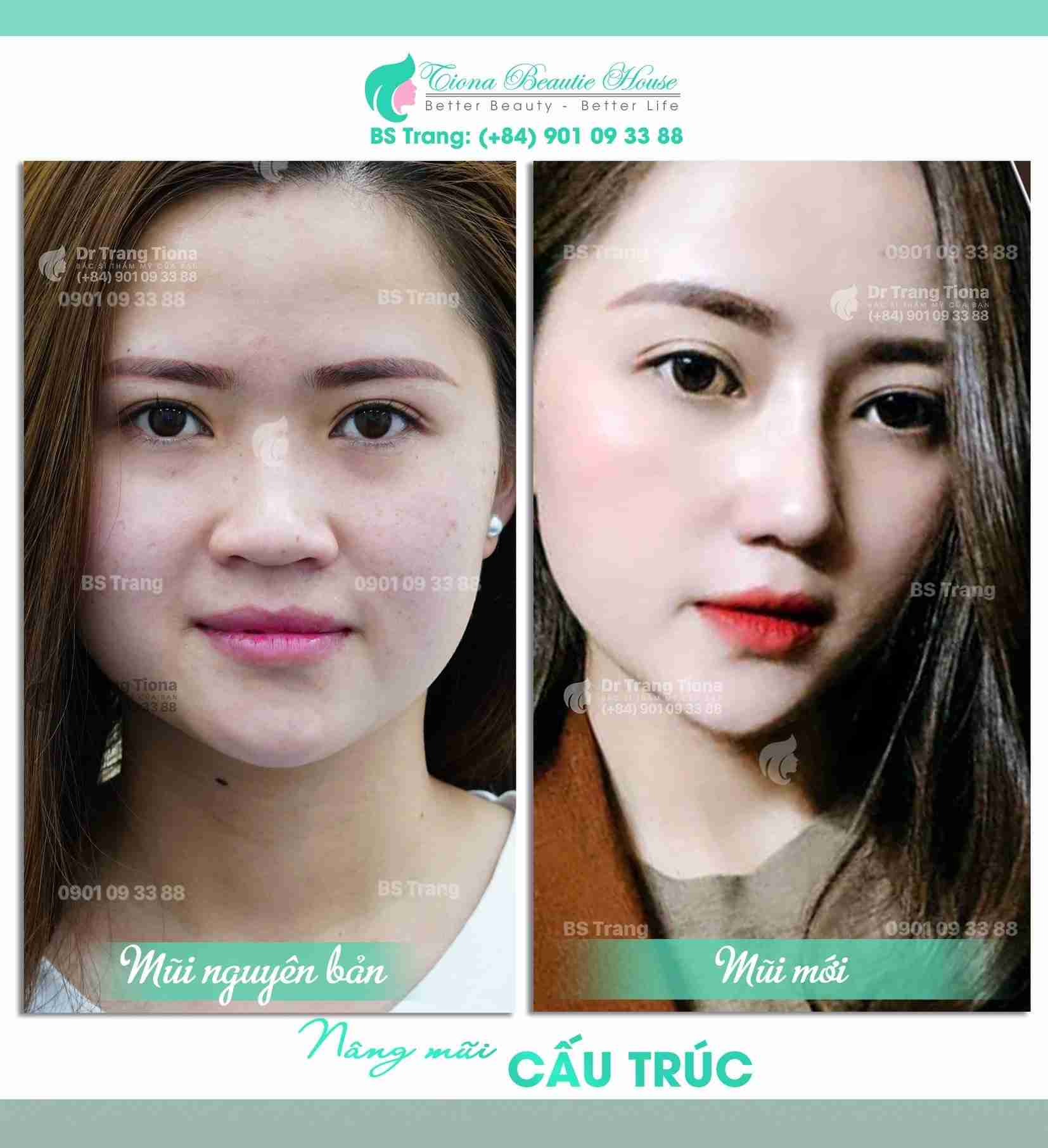 Mũi đầu to và cách khắc phục mũi đầu to để có dáng mũi cao như ý