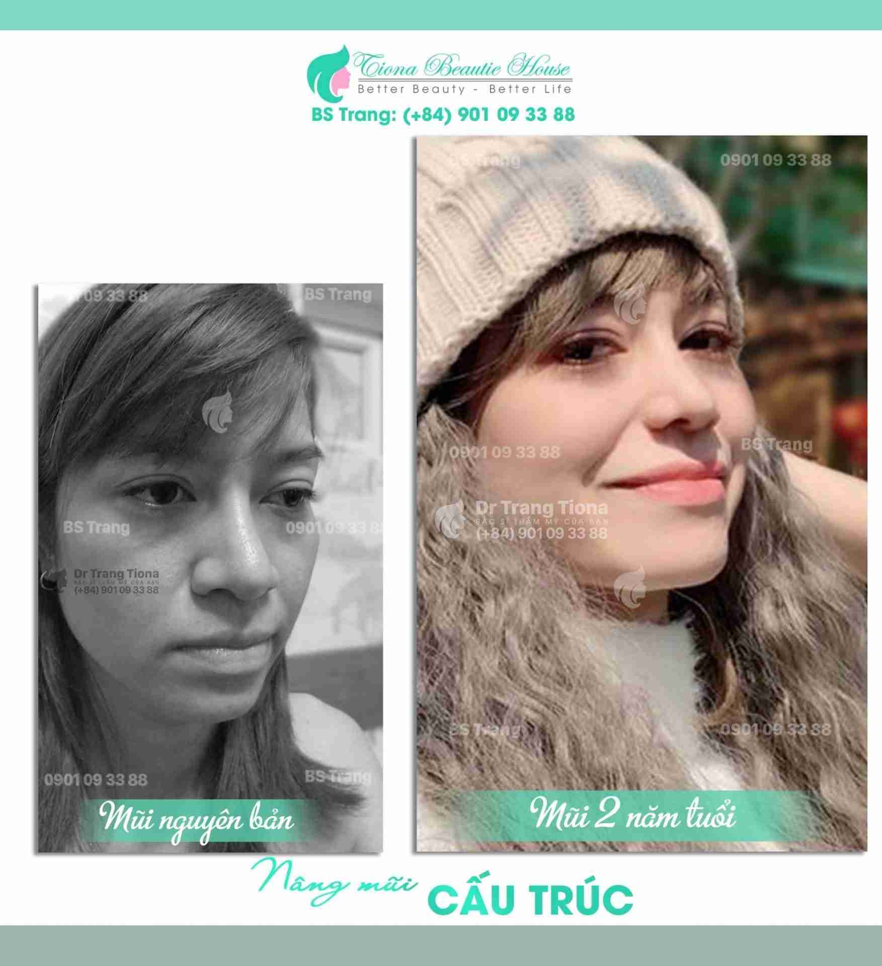 Mũi đầu to và cách khắc phục mũi đầu to để có dáng mũi cao như ý