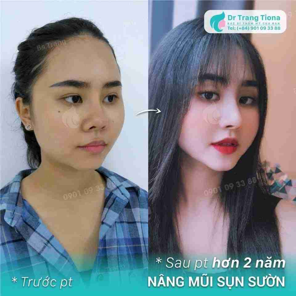 Mũi lân là gì? Có cần chỉnh sửa không?