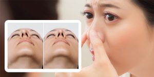 Mũi lệch sau nâng có tự hết không, khi nào cần sửa và giải pháp từ siêu vi phẫu