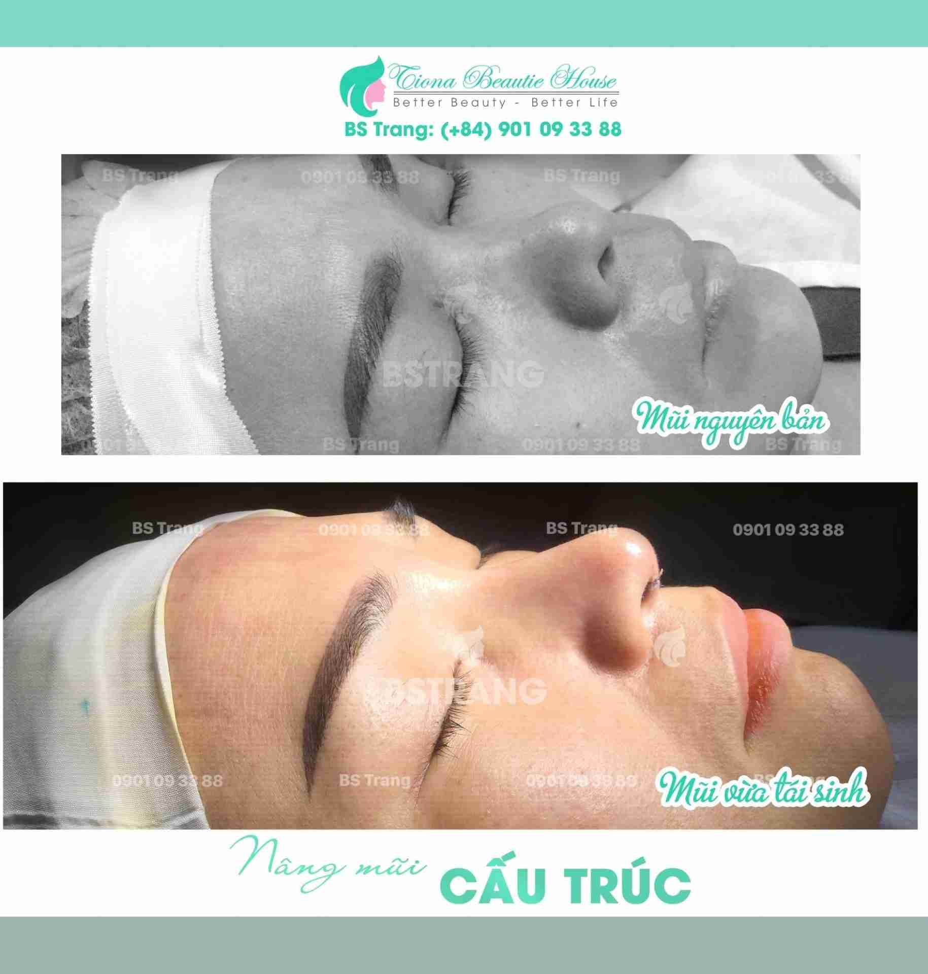 Tại sao mũi lệch vẹo và đâu là cách khắc phục mũi lệch vẹo hiệu quả?