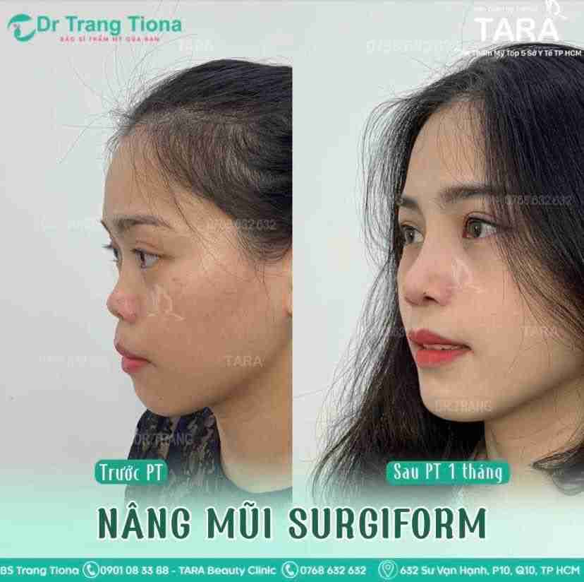 Mũi ngắn nên nâng mũi bằng phương pháp nào? Giá bao nhiêu?