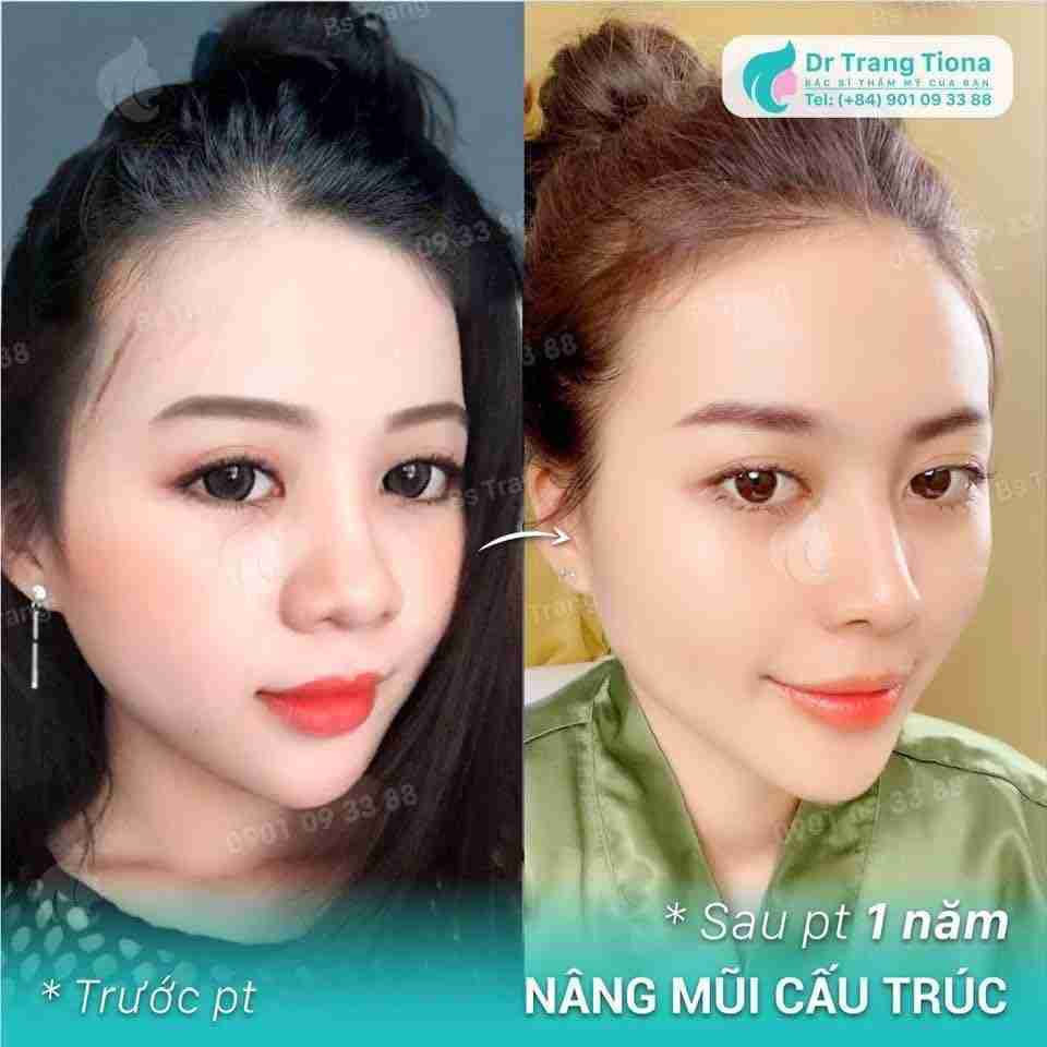 Mũi rồng là gì? Theo tướng số mũi rồng tốt hay xấu?