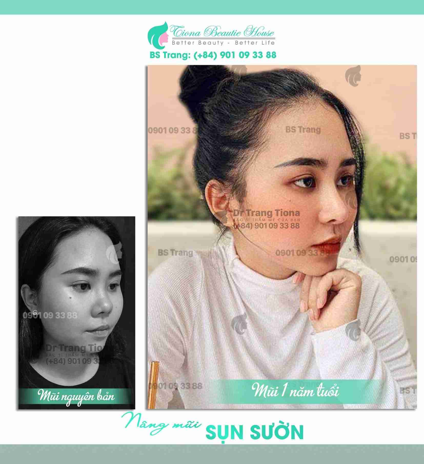 Mũi tẹt ảnh hưởng thế nào đến đời sống và tình cảm?