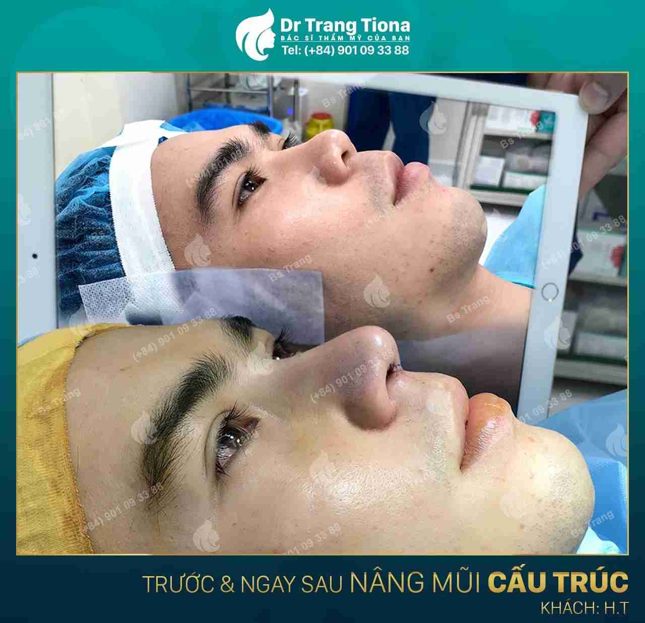 Mũi tẹt ảnh hưởng thế nào đến đời sống và tình cảm?