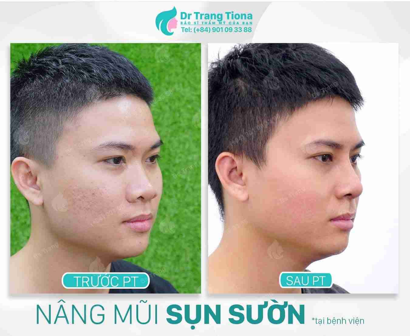 Nam giới nên nâng mũi bằng phương pháp nào thì nam tính?