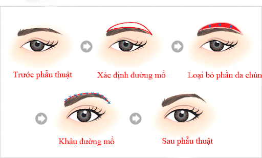 Nâng cung mày có giúp trẻ hóa mắt không?