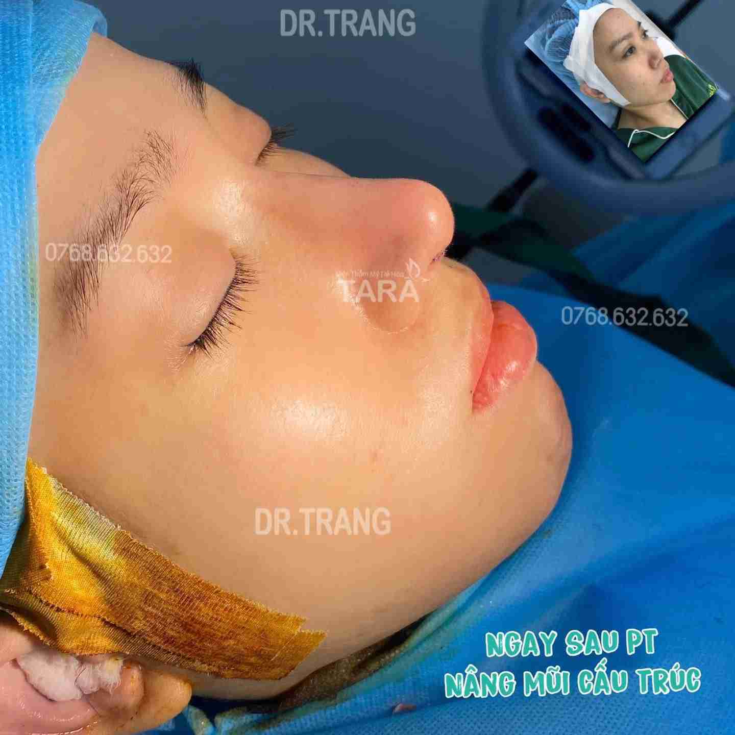 Nâng mũi ăn mì tôm được không và 3 lưu ý quan trọng
