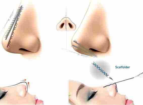 Nâng mũi bằng chỉ collagen hiệu quả như thế nào?