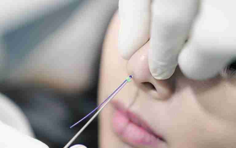 Nâng mũi bằng chỉ collagen hiệu quả như thế nào?