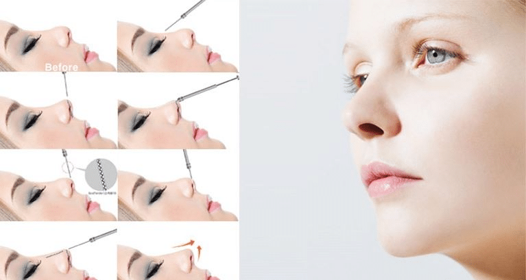 Nâng mũi bằng chỉ là gì? Có nên nâng mũi bằng chỉ không?