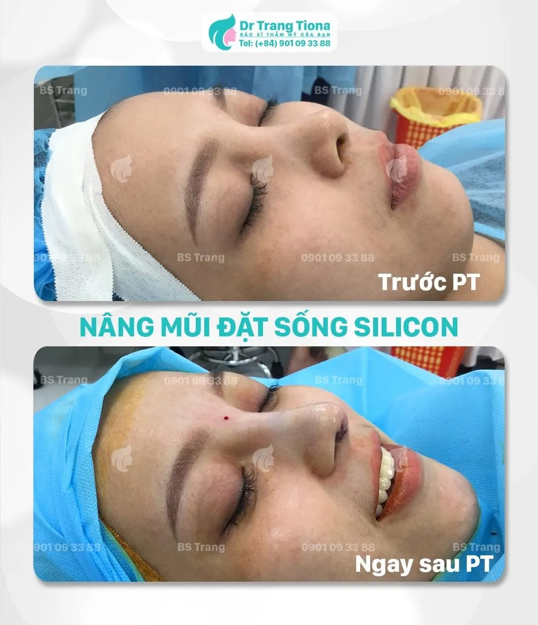 Phẫu thuật nâng mũi bằng silicon là gì? Có tốt không?