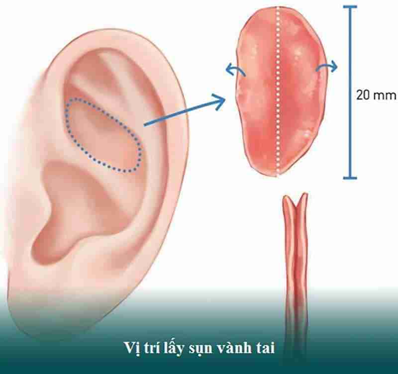 Bác sĩ giải đáp: Nâng mũi bằng sụn tai có bị teo không?