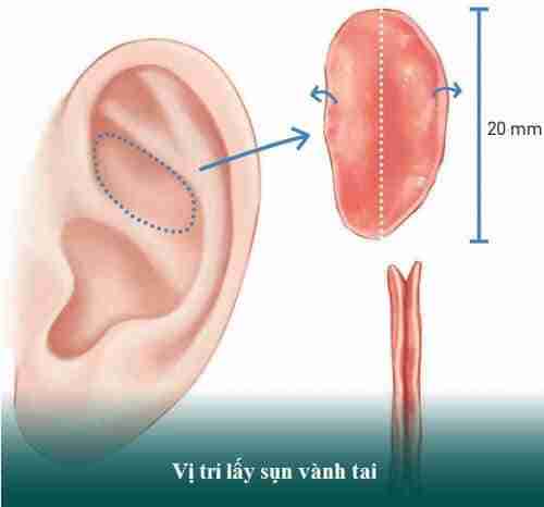 Nâng mũi bằng sụn tai có tốt không và lưu ý khi nâng mũi