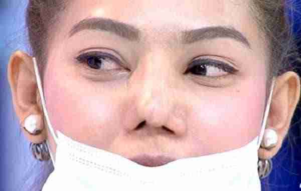 Nâng mũi bằng sụn tai thường bị những biến chứng nào?