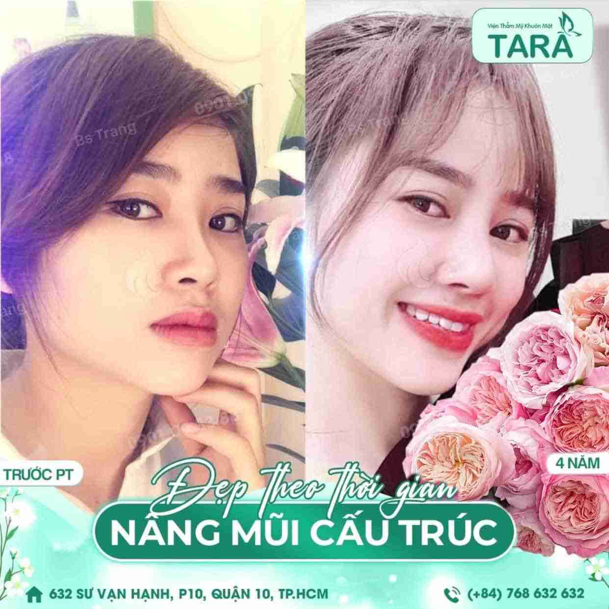 Nâng mũi bằng sụn tai thường bị những biến chứng nào?