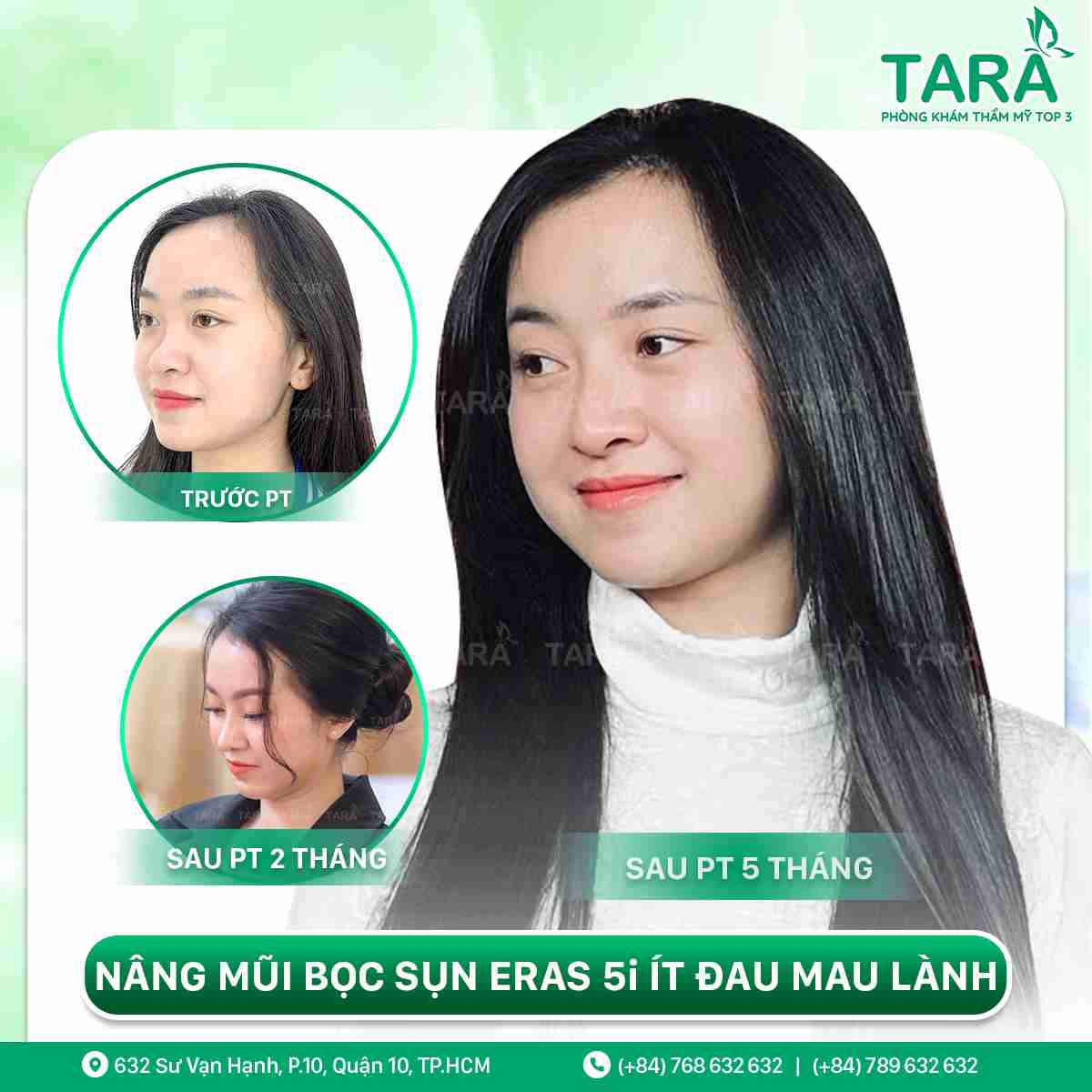 Nâng mũi sụn tự thân là gì? Có nên nâng mũi bằng sụn tự thân không?