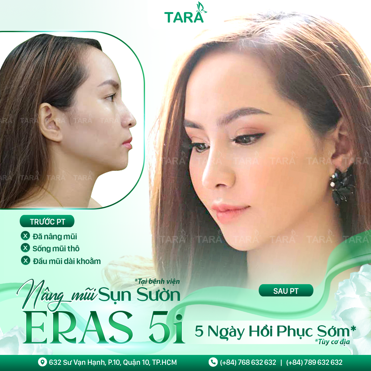 Nâng mũi sụn tự thân là gì? Có nên nâng mũi bằng sụn tự thân không?