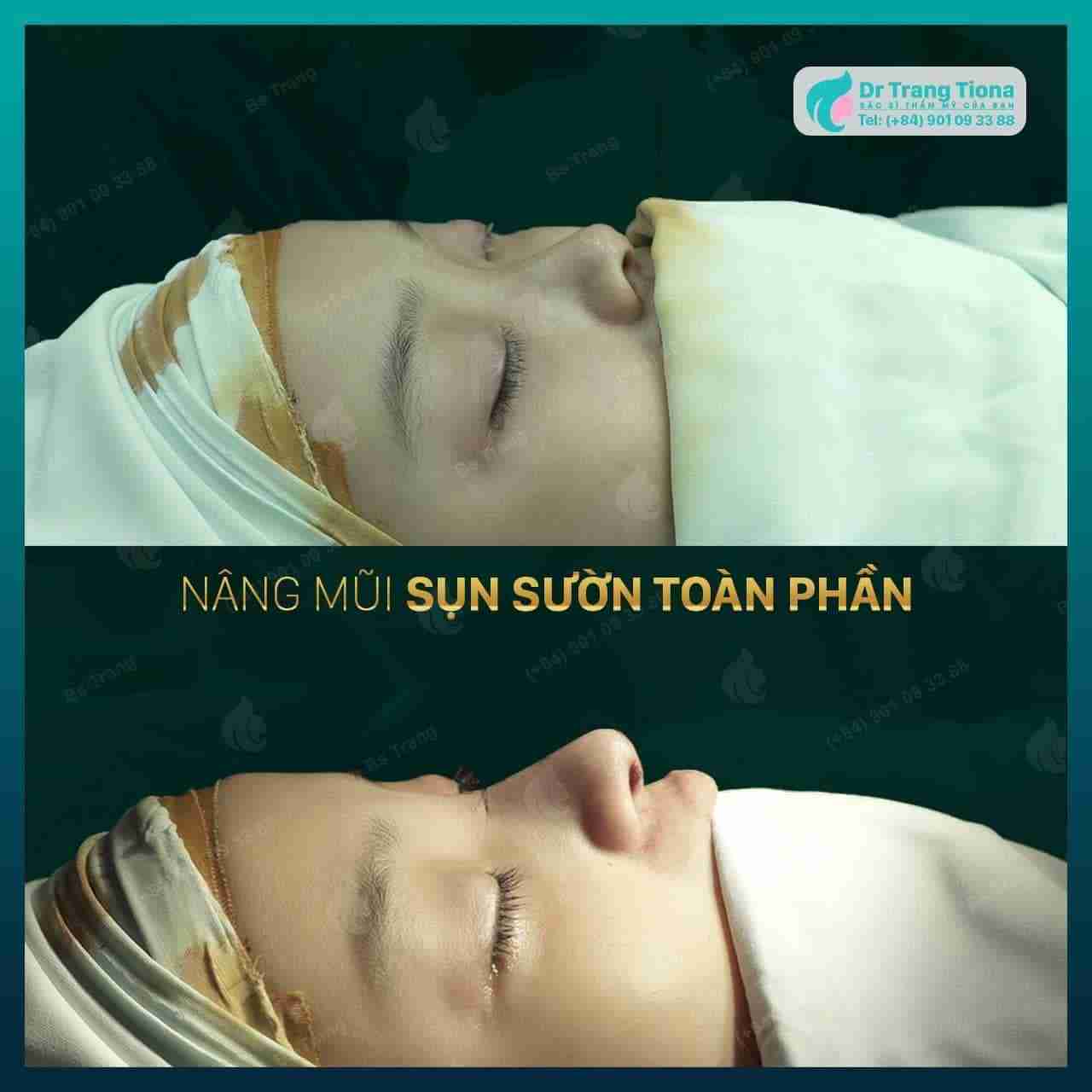 Nâng mũi sụn tự thân là gì? Có nên nâng mũi bằng sụn tự thân không?