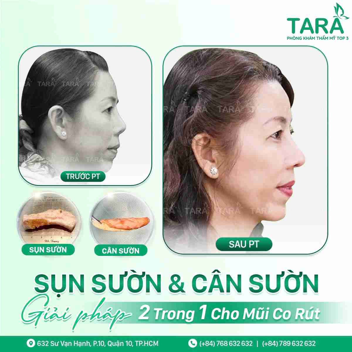 Nâng mũi sụn tự thân là gì? Có nên nâng mũi bằng sụn tự thân không?