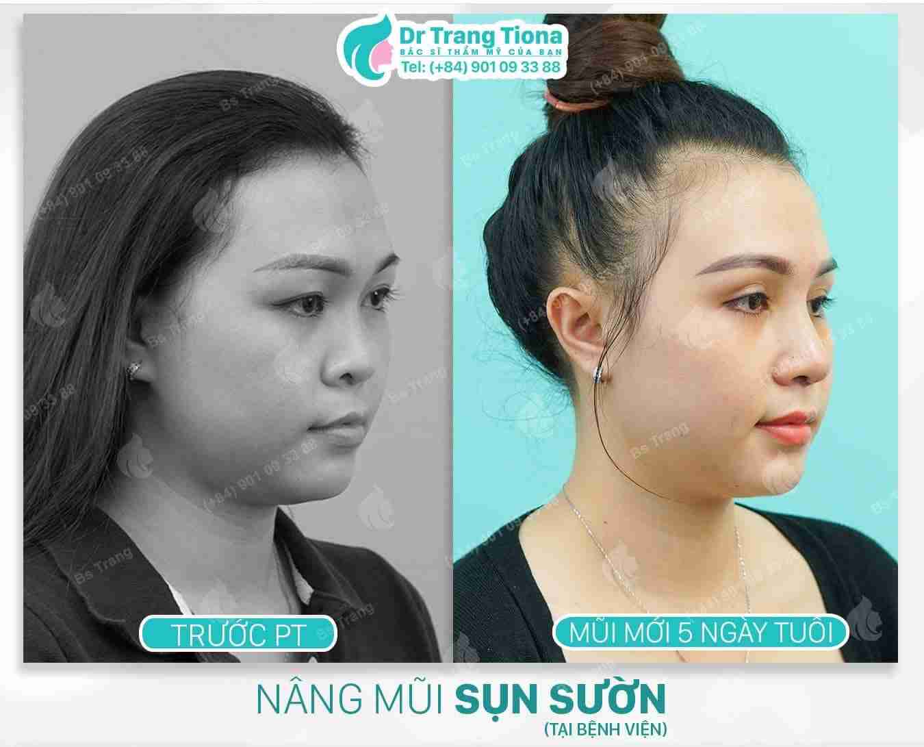 Nâng mũi sụn tự thân là gì? Có nên nâng mũi bằng sụn tự thân không?