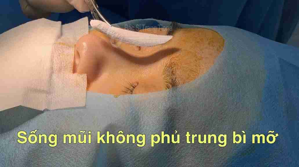 Nâng mũi bằng trung bì mỡ có thực sự tốt không?