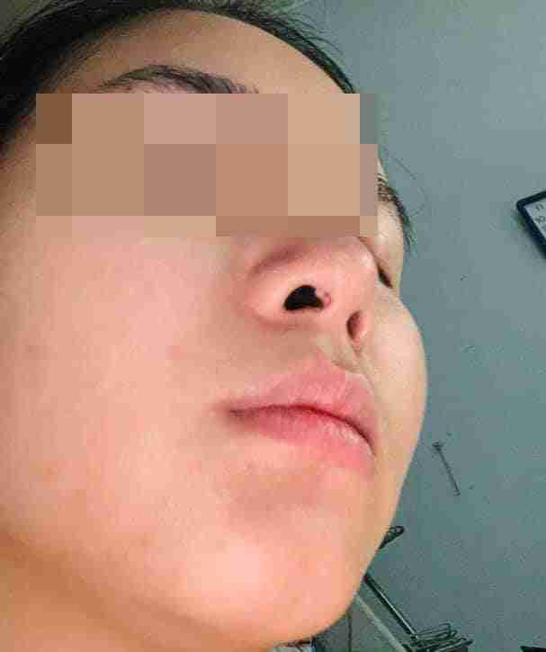 Nâng mũi bị lòi sụn bên trong có nguy hiểm không?