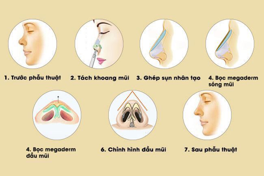 Nâng mũi bọc Megaderm là gì? Tốt như thế nào?