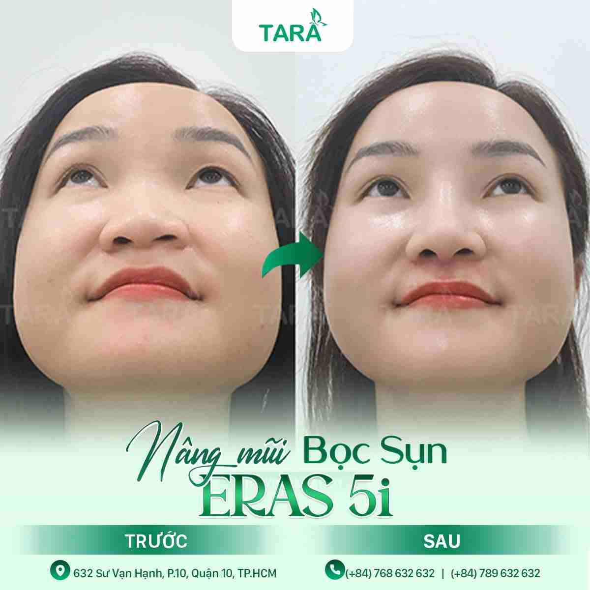 Bác sĩ giải đáp: Nâng mũi bọc sụn chỉ phù hợp với ai?