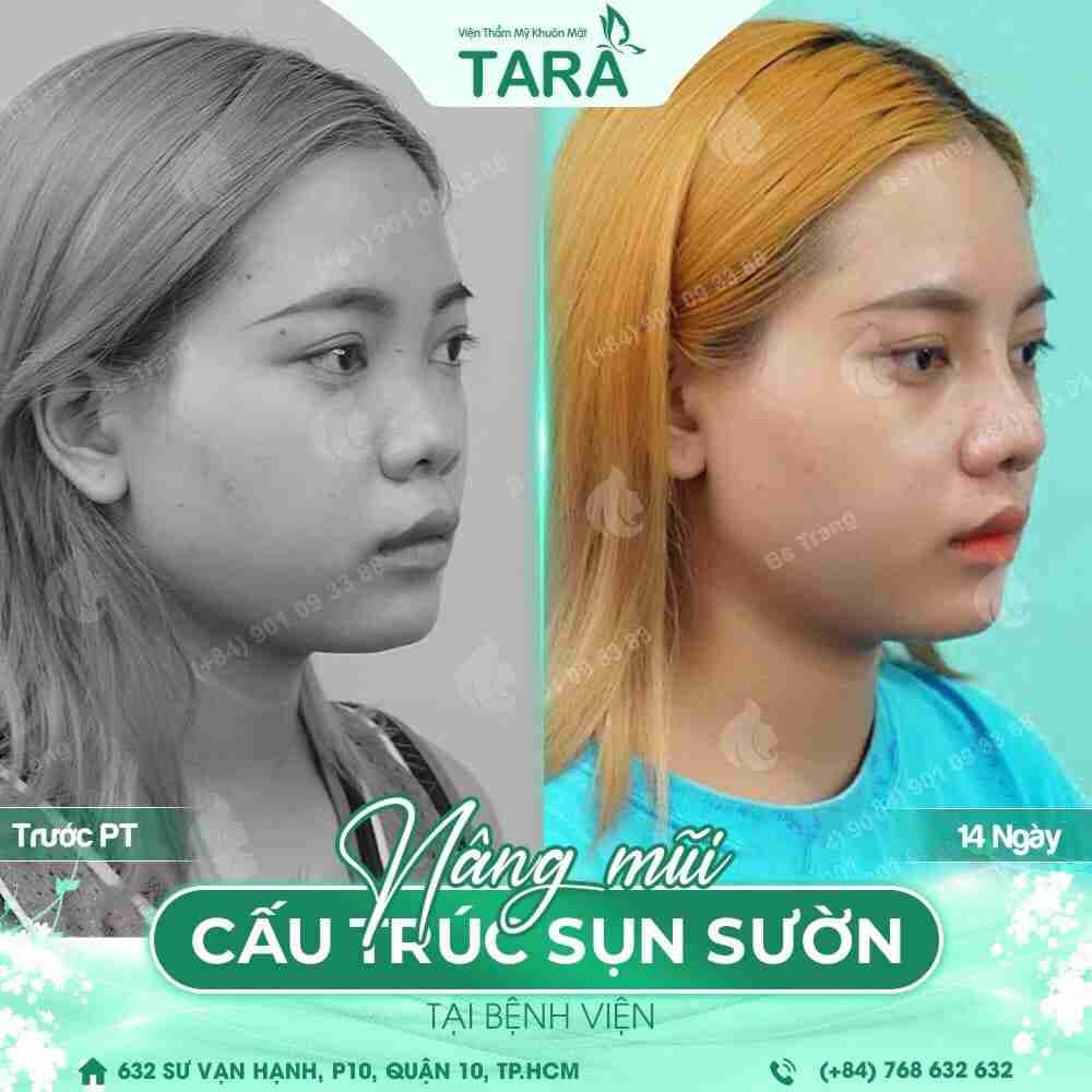 Nâng mũi bọc sụn ERAS 5i