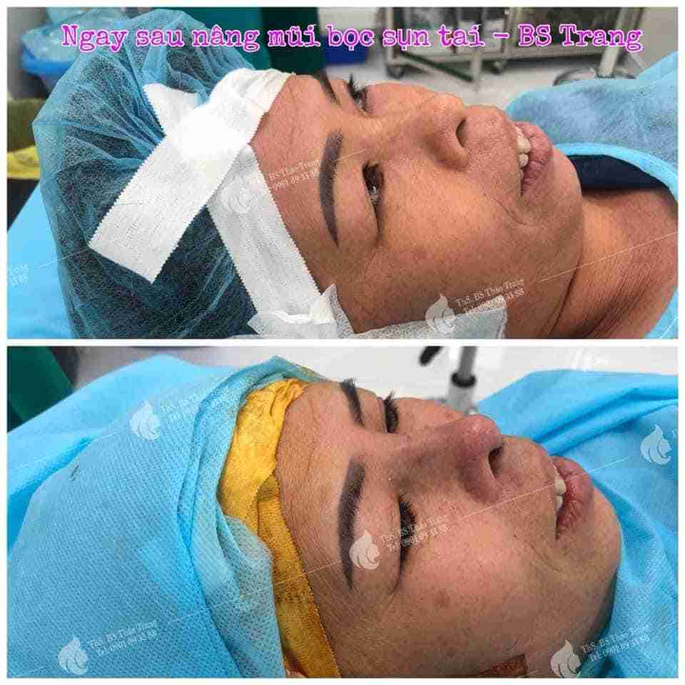 Nâng mũi bọc sụn là gì? Ai nên nâng mũi bọc sụn?