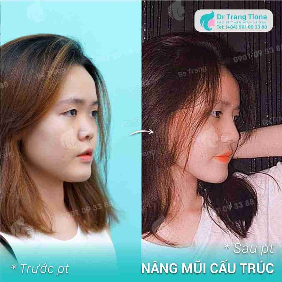 Bác sĩ trả lời: Nâng mũi cấu trúc bao lâu thì hết đau sưng đỏ?