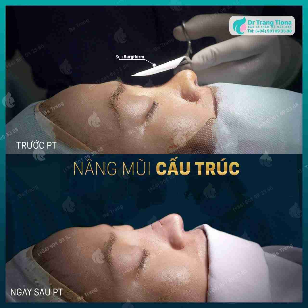 Nâng mũi cấu trúc có đắt không? Giá bao nhiêu?