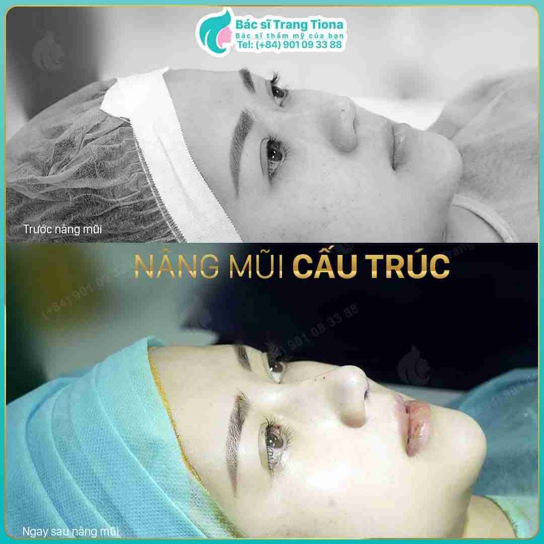 Nâng mũi cấu trúc duy trì hiệu quả bao lâu? 20 năm? 30 năm?
