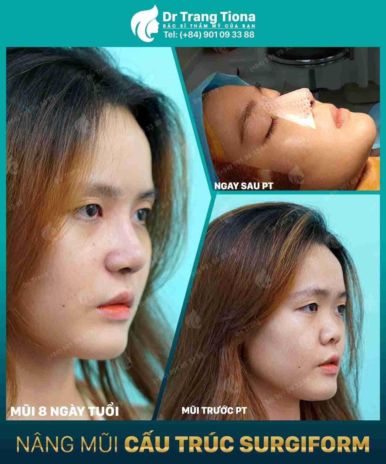 Nâng mũi cấu trúc duy trì hiệu quả bao lâu? 20 năm? 30 năm?